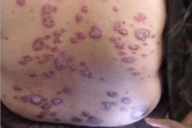 疣状红斑狼疮背部症状图 疣状红斑狼疮背部症状图