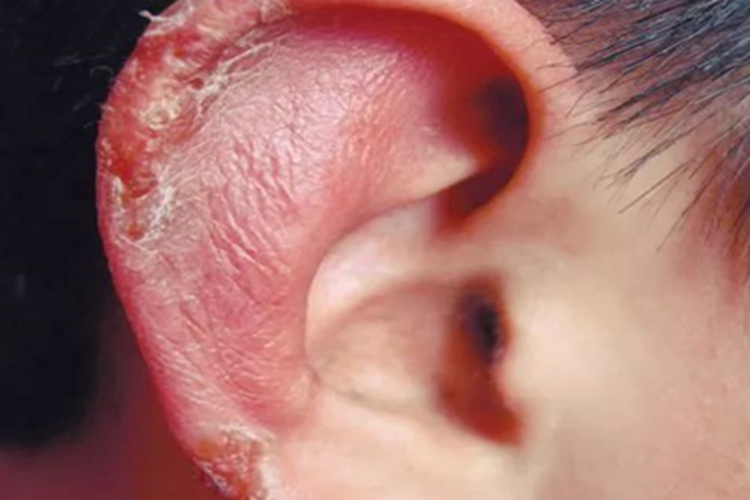 冻疮耳廓结痂图 冻疮耳廓结痂图