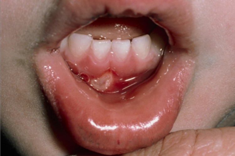 急性坏死性龈口炎牙龈糜烂图
