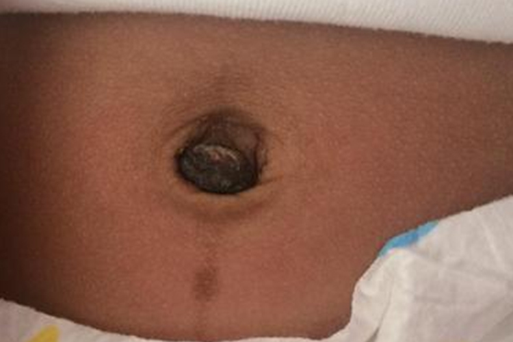 新生儿肚脐黑色结痂图 新生儿肚脐黑色结痂图