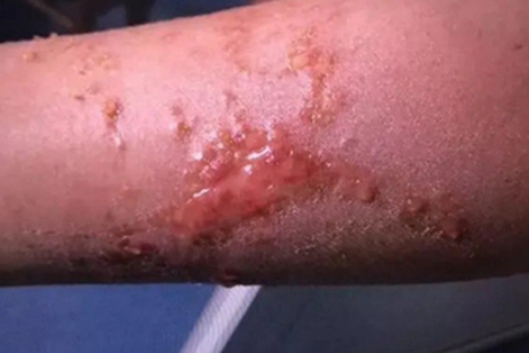 海蜇蜇伤胳膊症状图