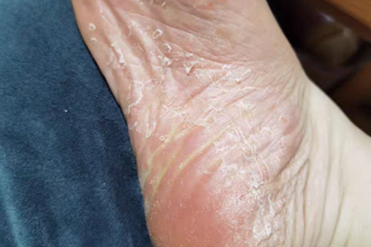 鳞屑角化型足癣脚底症状图