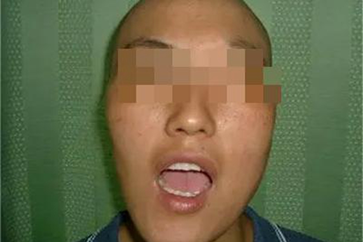 上颌窦癌面部症状图 上颌窦癌面部症状图