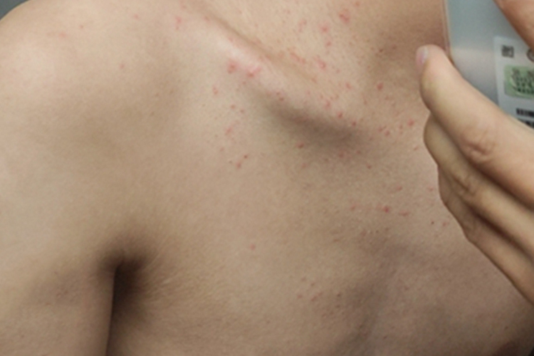 毛囊炎颈部下边很多小红点图