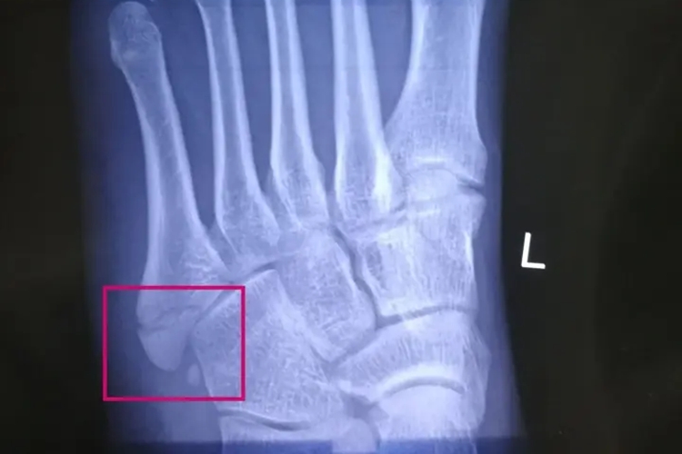 第五跖骨基底部骨折X线图 第五跖骨基底部骨折X线图