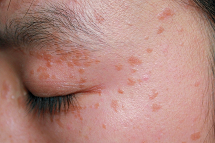 扁平疣眼周丘疹图