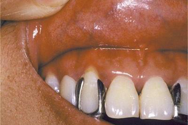 过敏性接触性口炎肿胀发红图