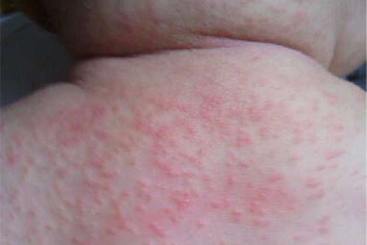 脓痱背部症状图