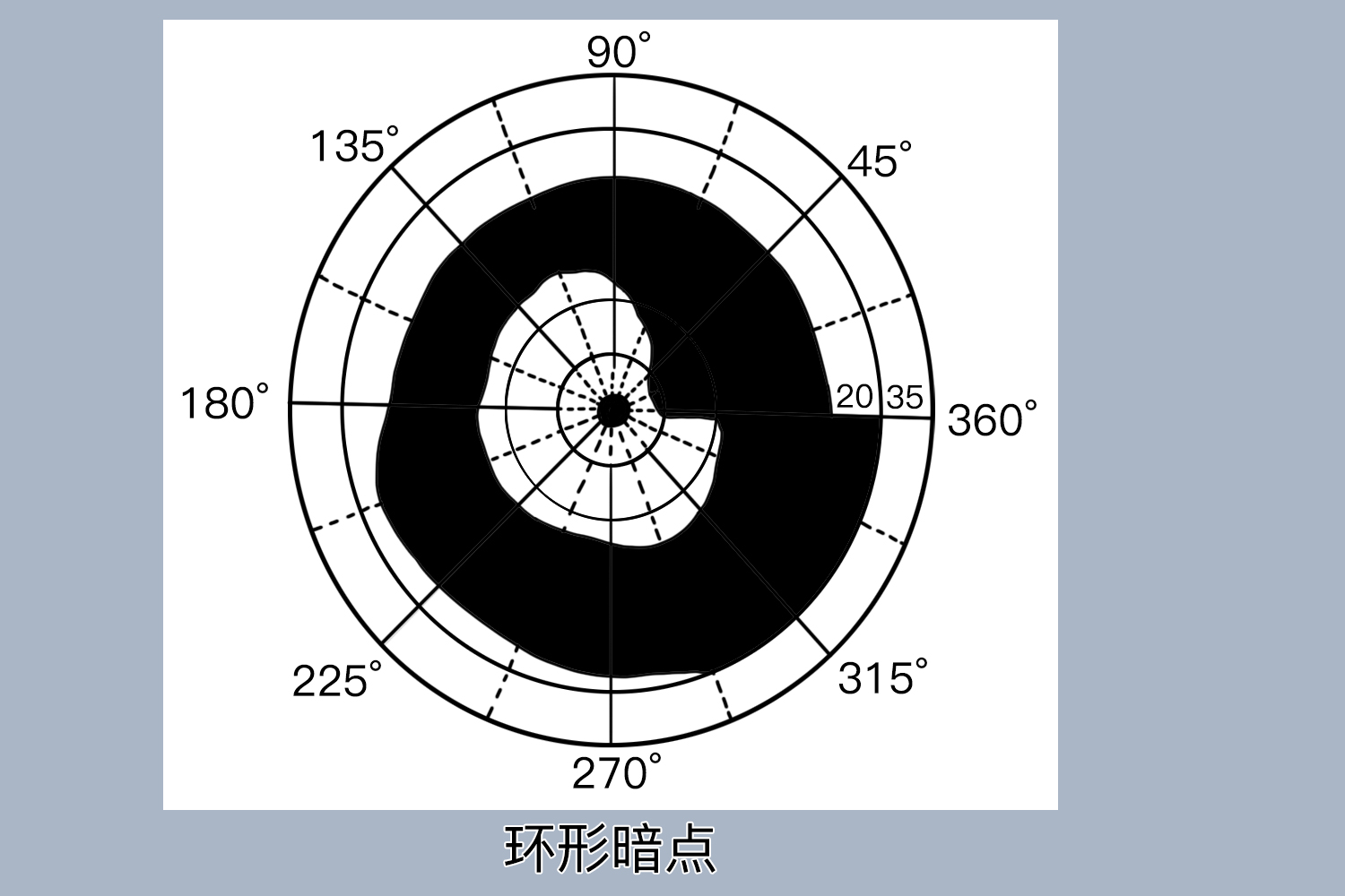 暗点视野缺损图