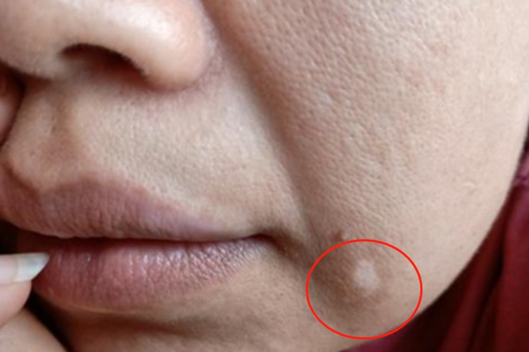 进展期节段型白癜风口周白点图