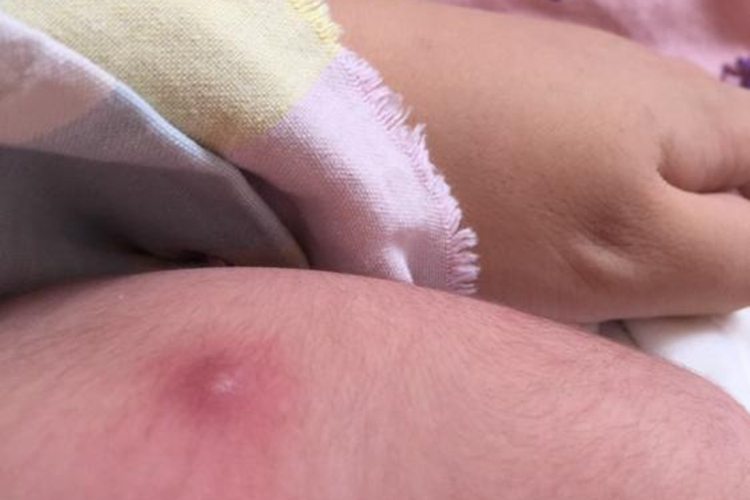 卡介苗接种后红肿图