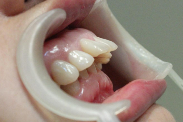 缺钙上颌牙齿前突图 缺钙上颌牙齿前突图