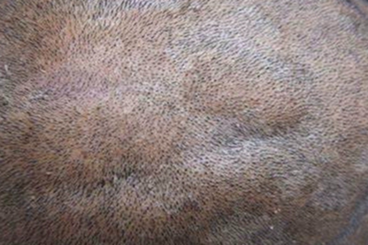 真性回状颅皮纹图