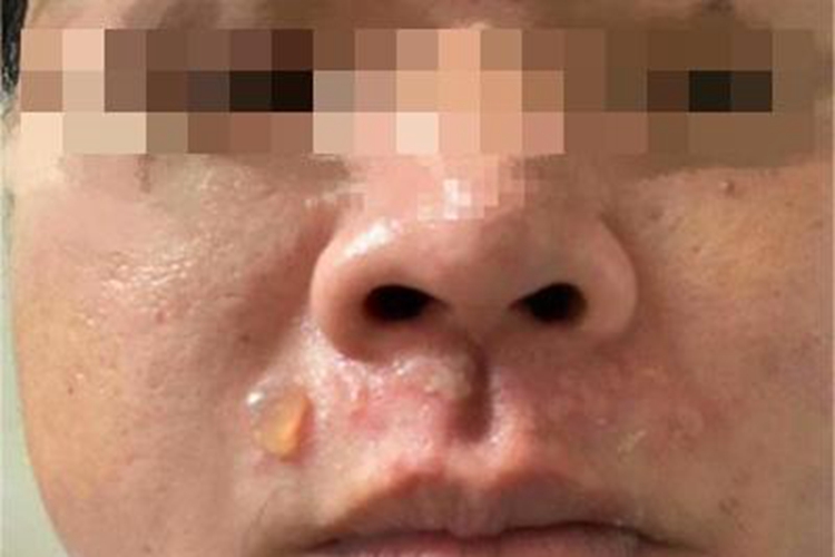 家族性良性慢性天疱疮口周长疱图