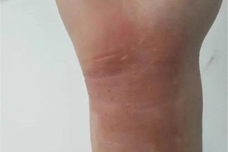 一度烫伤手腕症状图 一度烫伤手腕症状图