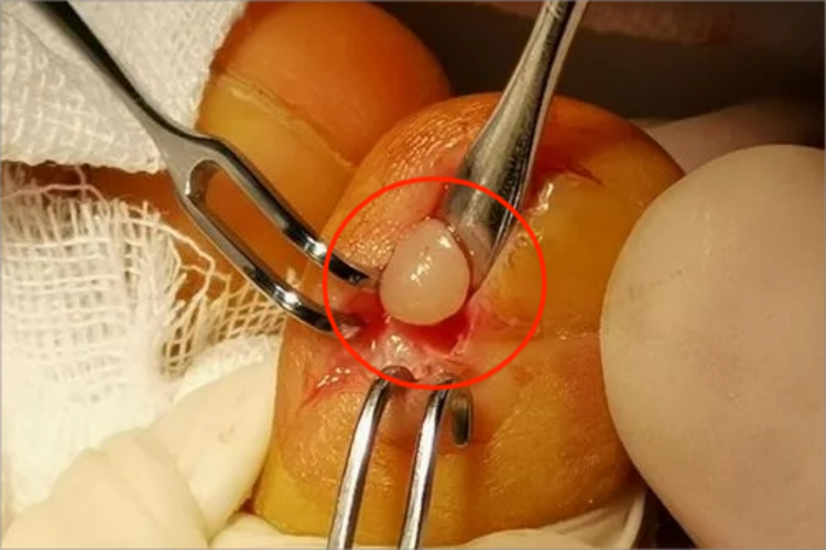 血管球瘤脚趾甲小疙瘩图