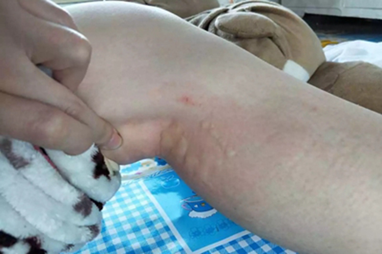 皮肤过敏红肿腘窝症状图