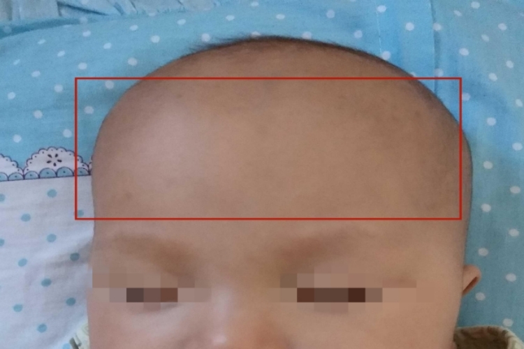 婴儿生理性额骨突出图