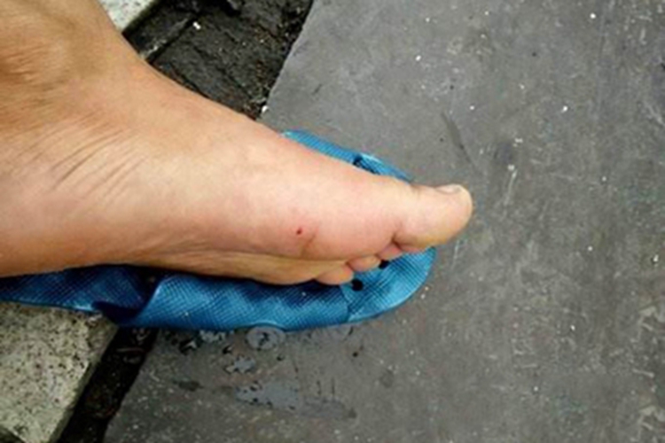 蜂蜇伤脚底症状图