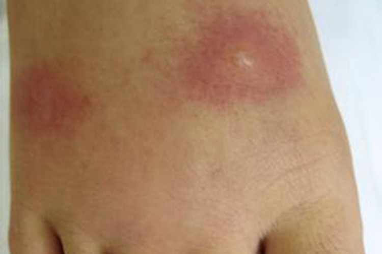 尾蚴性皮炎脚背丘疹图 尾蚴性皮炎脚背丘疹图