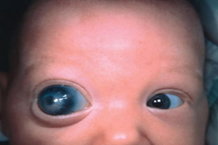 先天性青光眼宝宝症状图