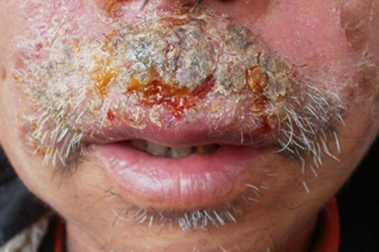 深在型须癣症状图