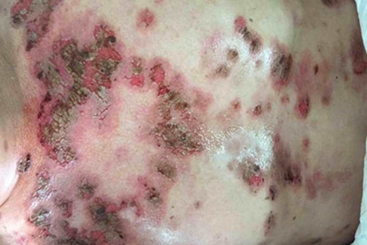 落叶型天疱疮胸部结痂图