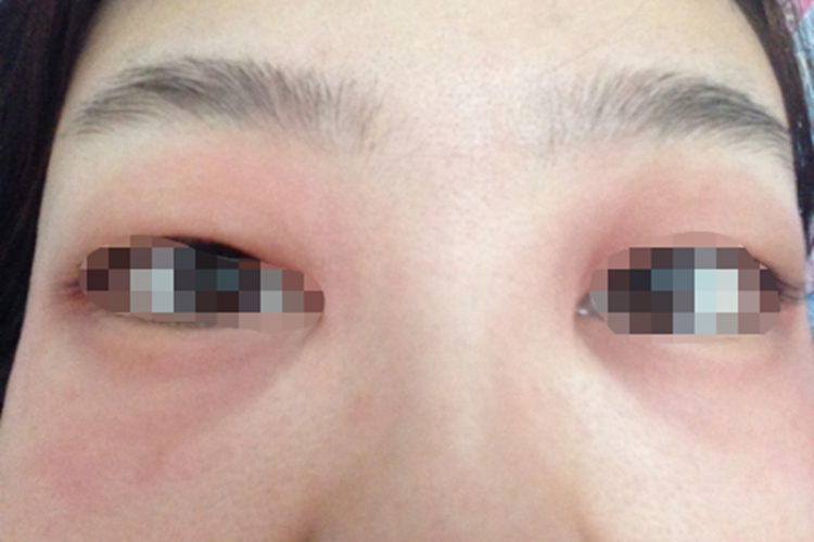 上眼皮荨麻疹图 上眼皮荨麻疹图