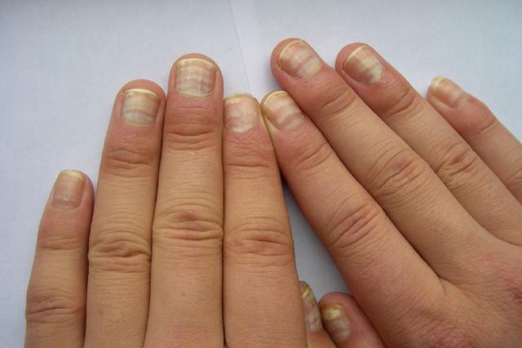 寄生虫感染手指甲波浪纹图