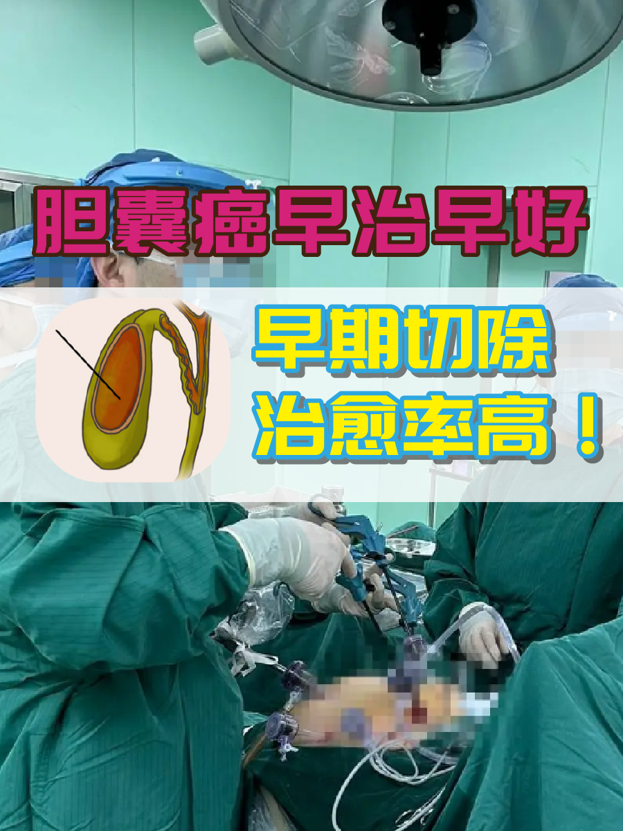 胆囊癌早治早好，早期切除治愈率高！