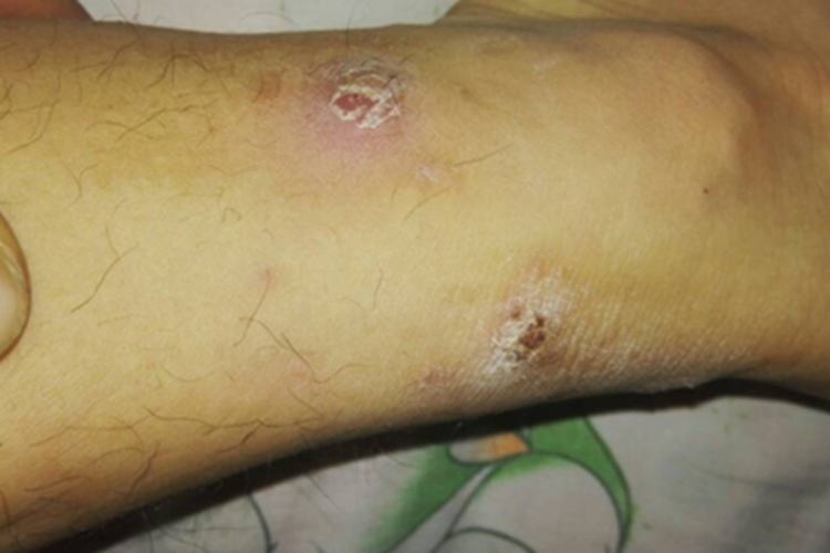 皮肤猪囊虫病小腿结痂图 皮肤猪囊虫病小腿结痂图