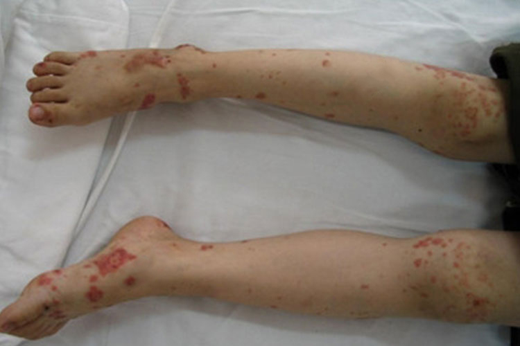 慢性血小板减少性紫癜图