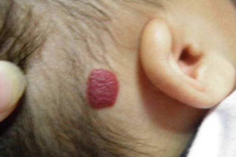 浅表型婴儿血管瘤耳后症状图