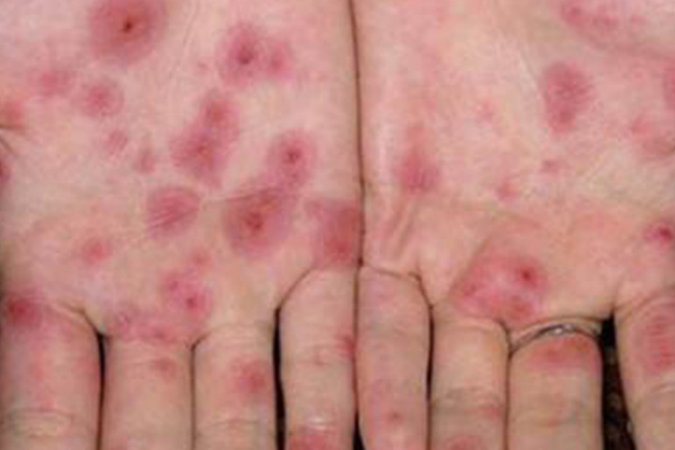 二期梅毒手掌发红图