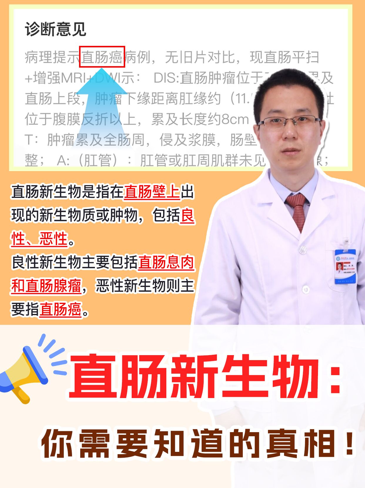 直肠新生物：你需要知道的真相！