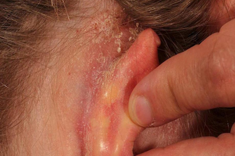 外耳湿疹耳后粗糙图