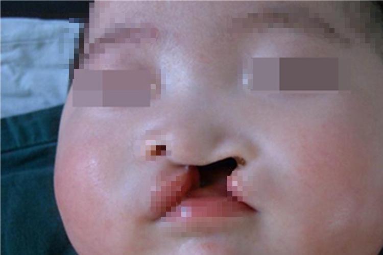 Ⅲ度唇裂嘴唇畸形图