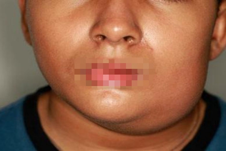 流行性腮腺炎面部肿大图