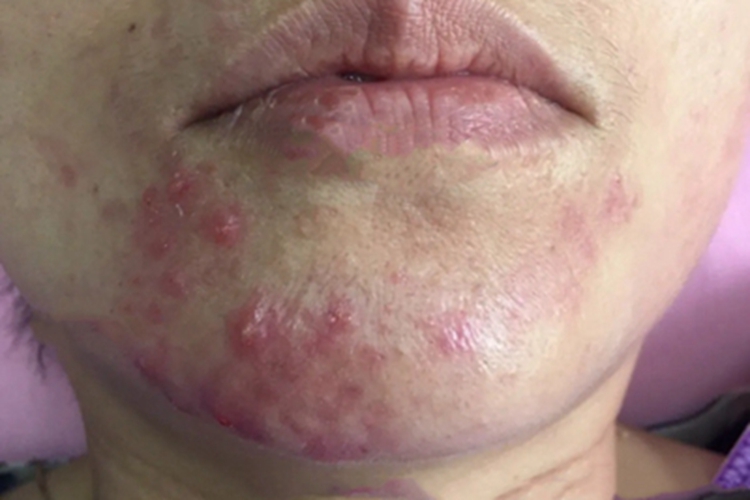暴发性玫瑰痤疮下巴小红疙瘩图