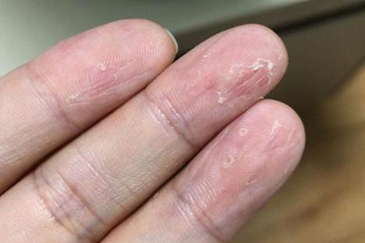 真菌感染手指头干瘪有竖纹图