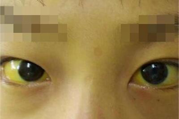 胆汁淤积性黄疸症状图