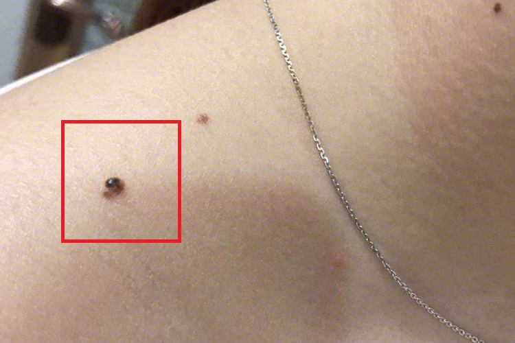 黑素瘤肩部结节图