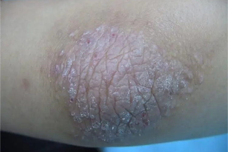 局限性神经性皮炎肘部长斑图 局限性神经性皮炎肘部长斑图