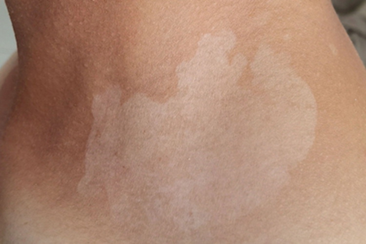 花斑糠疹颈部白斑图