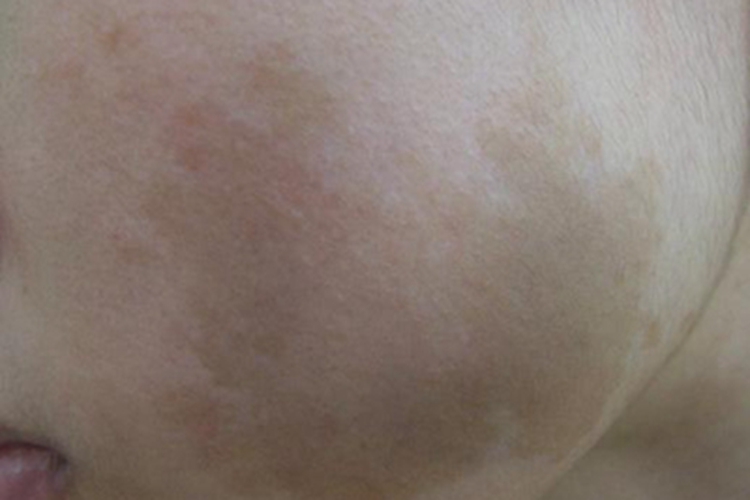 咖啡斑脸上大块淡棕色斑图