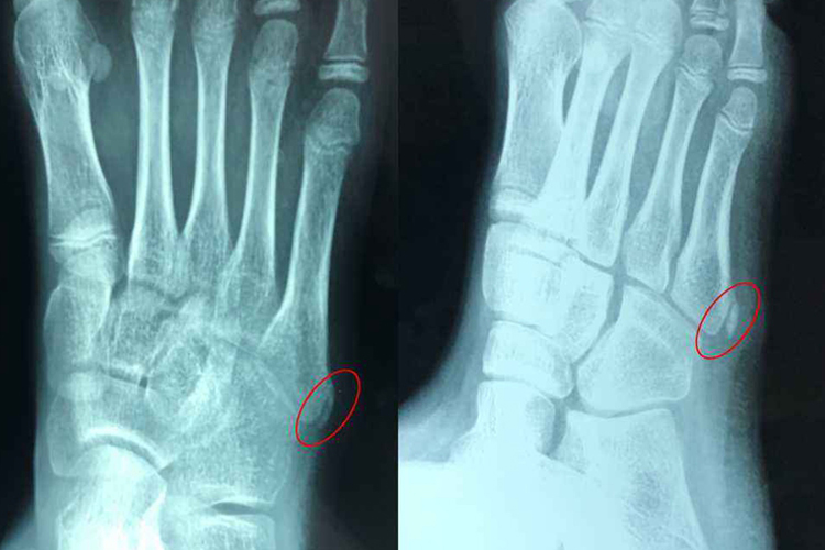 儿童第五跖骨骨骺图 儿童第五跖骨骨骺图