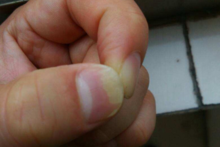 甲分离指甲发黄分离图 甲分离指甲发黄分离图