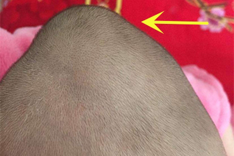 头皮血肿头部大包图