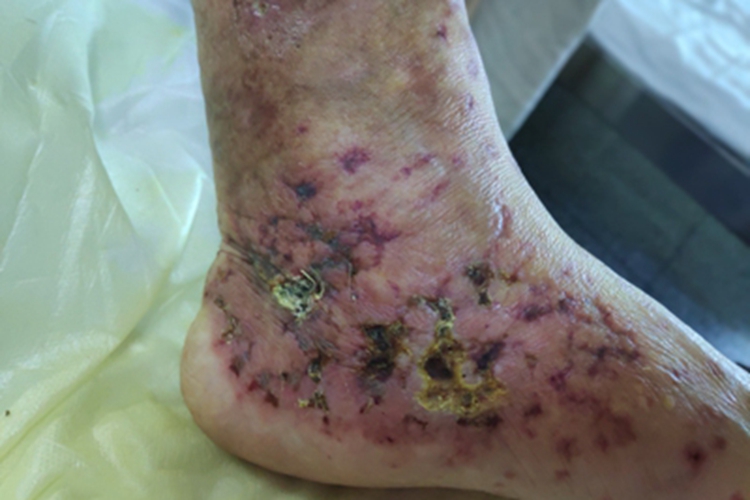 青斑性血管病脚踝症状图