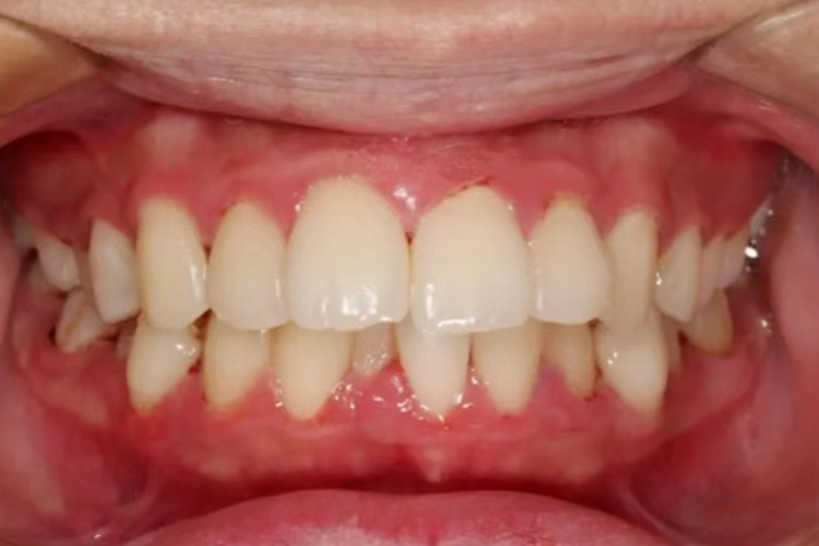 下颌骨内翻图片和外翻的区别_有来医生